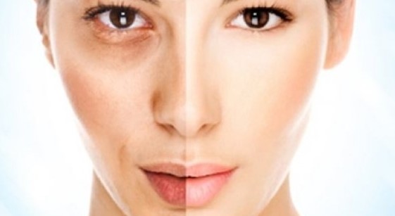 Yağlı Ciltler için Evde Maske Tarifleri Flash Resim Flash Resim