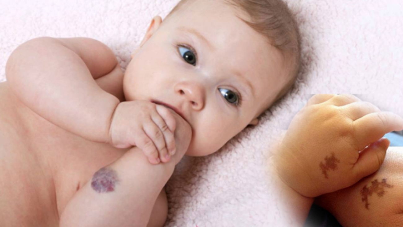 Bebeklerde Doğum Lekesi Neden Olur?